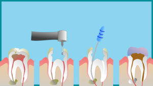 root_canal